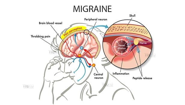 மைக்ரேன் தலைவலி வருவதற்கான காரணங்கள்.. 4 Micron headache. thinatamil |