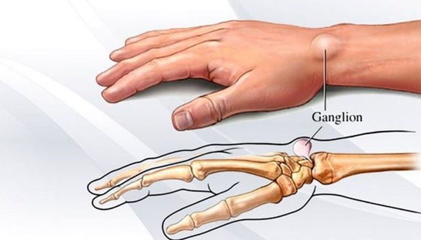 Wrist ganglion cyst. thinatamil |
