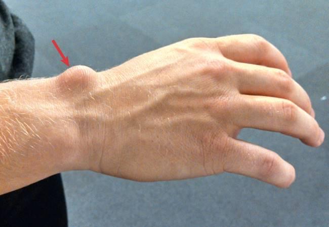 Wrist-ganglion-cyst_thinatamil