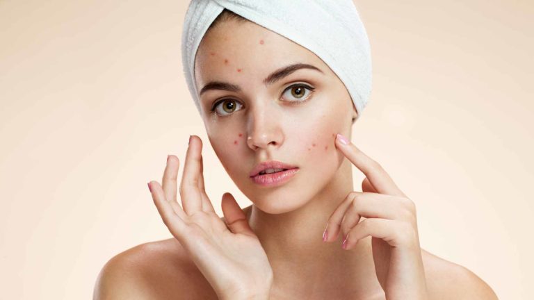 pimples-on-face-natural-treatment-at-home_thinatamil