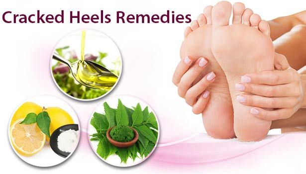 cracked-heel-remedies-for-women-thinatamil