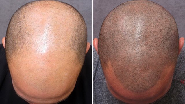 are-you-need-to-grow-hair-in-bald-head-thinatamil