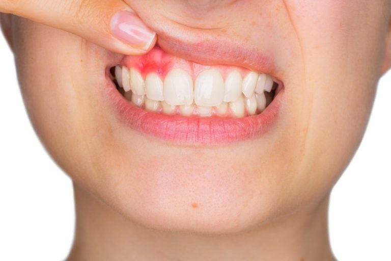 Bleeding-Gums-healthy-tips-thinatamil