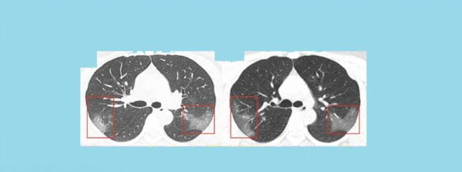 corona-virus-lungs-thinatamil