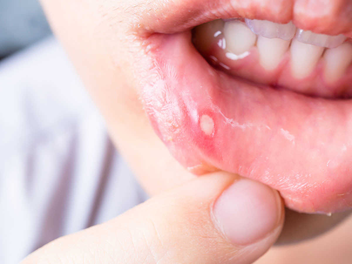 வாய்ப்புண்ணை போக்கும் பப்பாளி -papaya cures Mouth sore mouth-sore-medicine-thinatamil